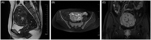 Figure 2. Magnetic resonance imaging (MRI) results obtained from a 28-year-old patient with diffuse uterine leiomyomatosis (DUL).The sagittal (A), transverse (B) and coronal (C) T2-weighted images revealed an enlarged uterus fulfilled with innumerable fibroid nodules in each layer of the uterus before HIFU treatment. Each uterine myoma was less than 30 mm in dilation and displayed a low signal on T2WI.