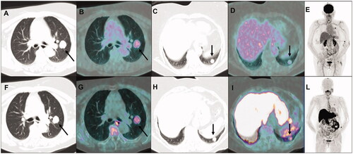 Figure 1. Transaxial co-registered CT and fused images of 18F-FDG PET/CT showing increased tracer uptake in the left upper lung lobe nodule (A and B, arrows), but only weak glucose activity in the lower lobe nodule (C and D, arrows); maximum intensity projection image (E) showing no other sites of abnormal 18F-FDG uptake. At subsequent 11C-methionine PET/CT, transaxial co-registered CT and fused images showed increased and similar uptake of amino acidic tracer both in the left upper lung lobe nodule (F and G, arrows) and in the lower lobe nodule (H and I, arrows); maximum intensity projection image (L) showing no other sites of abnormal 11C-methionine uptake, so suggesting ACC oligo-metastatic lung involvement.