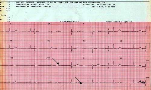 Figure 1 Electrocardiogram revealing complete atrioventricular block with junctional escape rhythm (arrows).