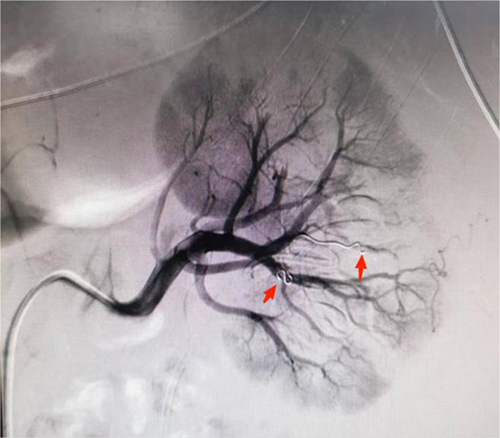 Figure 3 The second instance of SRAE showing the artery embolized with a gelatin sponge and an unobstructed lower polar artery (red arrows).