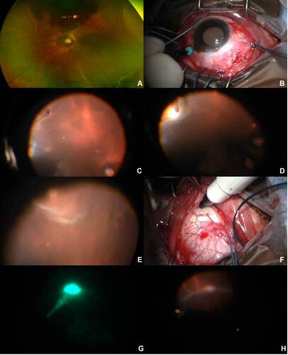 Figure 1 Endolaser assisted Chandelier Scleral Buckling. (A) Ultra-wide field color fundus photograph of the left eye discloses an inferotemporal rhegmatogenous retinal detachment involving the macula with a retinal break at 4 o’clock. (B) A 25-gauge valved trocar is placed 90 degrees from the main source of pathology and a chandelier introduced and manipulated by the surgeon dynamically. (C) Intraoperative view with chandelier-assisted endoillumination reveals the main causative break. (D) Cryotherapy is applied to the main retinal break under direct visualization. (E) A second retinal break is found at 6 o’clock during scleral depression. (F) A marking pen is used to highlight the area just posterior to the most posterior retinal break as marked by the scleral depressor. (G) After insertion of the encircling band, continuous endolaser is applied to the most posterior break. (H) Direct visualization demonstrates adequate uptake and retinopexy.