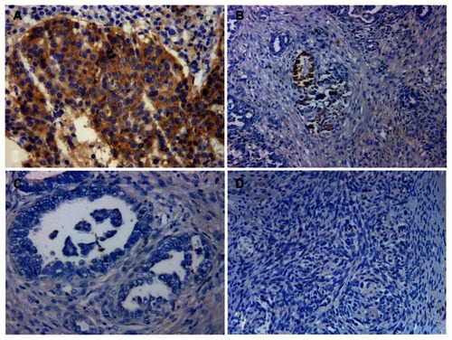 Figure 1 Representative images of CD70 immunostaining in ovarian cancer tissues. (A) high CD70 expression; (B) low CD70 expression having <10% of tumor cells with strong staining intensity; (C) low CD70 expression with totally negative staining; (D) negative control (primary antibody was replaced by immunoglobulin G).