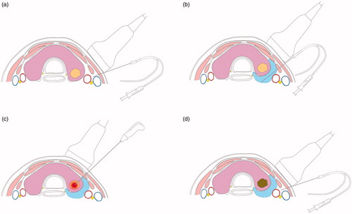 Figure 4. Simulation diagram of main steps (a) Initial Vagal Stimulation (b) Detection of RLN and Hydrodissection Technology (c) US-Guided RF Ablation (d) End of RFA Neural Testing.