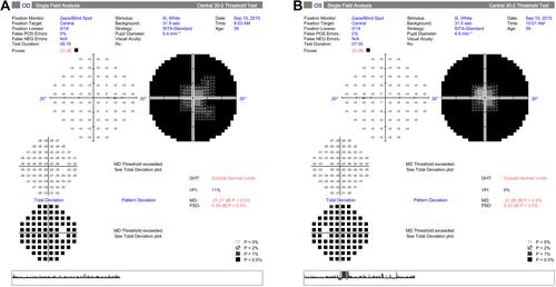 Figure 1 Visual Field Analysis. Visual field analysis showed peripheral deep scotoma with a central residue of about 20 degrees in the right eye and 10 degrees in the left eye.
