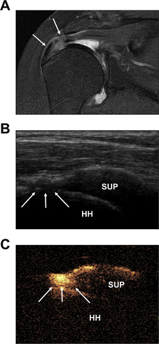 Figure 3 Representative figure of full-thickness RCT on the SUP. (A) The oblique coronal T2-weighted image showing the high signal with the interrupted continuity within the SUP (↓↓). (B) The demonstration of two-dimensional ultrasound examination on the continuity of SUP in the middle segment and the extension from bursal surface to the articular surface (↓↓↓). (C) The mixture of contrast agent enters the SUP from the bursa and reaches the surface of the HH, along with a strong echogenicity (↓↓↓).