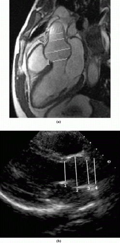 Figure 1. Parasternal long axis view showing the aortic root and locations of the four measurements in both cine MRI (a) and Echo (b).