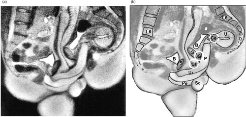 Fig. 5 Magnetic resonance image (MRI) of a penis inside a vagina. Participant couple was in the ‘missionary position’. Note the ‘boomerang’ curvature of the penis to meet the shape of the vagina. Left: MRI image. Right: image with approximate anatomical locations of external clitoris, internal clitoris or ‘G-spot,’ and cervix, as in Fig. 4. Images adapted from Schultz, van Andel, Sabelis, and Mooyaart (Citation1999) and reprinted with permission. P, penis; Cl, clitoris; G, G-spot; Ce, cervix; Ur, urethra; Pe, perineum; U, uterus; S, symphysis; B, bladder; Sc, scrotum.