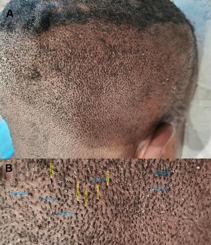Figure 1 Example of thick/firm scalp. Patient 1 - a male patient of African descent. Right posterior oblique view of the scalp: Thick firm scalp manifesting (A) closer up view showing hair bunching/bouquet hair (yellow arrows), with hooding of hair exit points (blue arrows) (B).