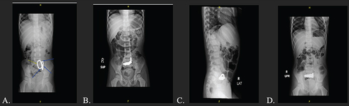 Figure 1 (A) Nonspecific abdominal bowel gas pattern and distribution with no radiological signs of intestinal obstruction or free intraperitoneal air. Radiopaque dated foreign body projects over the region of the midline in the pelvis (probably represent an external artifact well as indicated by arrows on the image). (B, C and D) The previously noted beaded foreign object is again seen suggesting it is intra-abdominal. There is mild dilatation of the proximal bowel loops with multiple air-fluid levels suggesting partial lower intestinal obstruction. Air was noted within the rectum. No pneumoperitoneum.