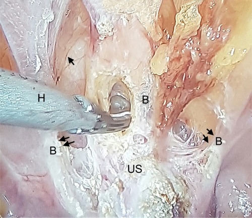 Figure 5 Retroperitoneal vascular markings of the uterovesical fold (arrow).