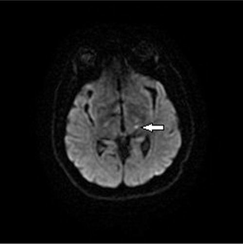 Fig. 1 Axial Diffusion-weighted MR image showing punctate focus of increased signal in Lt. posteroinferolateral region of thalamus (arrow).