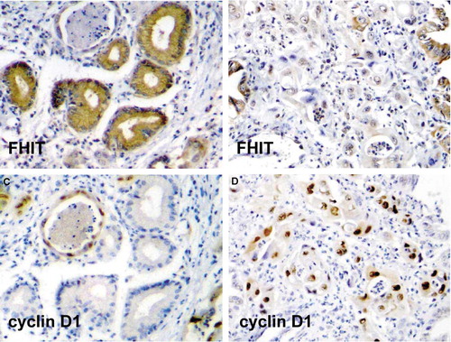 Figure 1.  The results of immunohistochemical staining in cholangiocarcinoma. It was showed a positive staining for FHIT in the normal bile ducts (A), but a negative staining in the infiltrating tumour cells (B). On the contrary it was showed a negative staining for cyclin D1 in normal bile ducts (C), but a strongly positive staining in the corresponding tumour cells at the serial slides (D)[A, B, C, D: 200×].