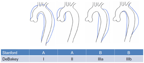 Figure 1 DeBakey and Stanford classification systems for aortic dissections. Note the DeBakey system distinguishes between dissections of the ascending aorta that extend into the aortic arch and those that do not. The Stanford system makes no such distinction.