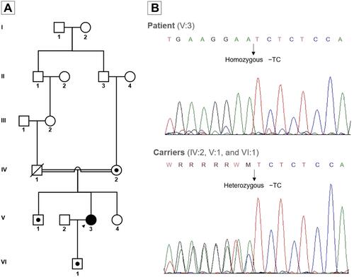Figure 3 Family pedigree and Sanger sequencing. (A) Pedigree demonstrating consanguineous relationship in the patients’ parents and carrier status of the frameshift mutation c.133_134delTC in exon 3 of the APOC2 gene. Arrow: index case; black symbol: familial chylomicronemia syndrome; black dot: heterozygous carriers (B) Sanger sequencing electropherogram of the patient and carriers of the frameshift mutation in the APOC2 gene.