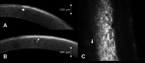 Figure 2 (A) Anterior segment optical coherence tomography (AS-OCT) of the right eye horizontally and (B) vertically in patient 1, demonstrating mostly continuous, homogenous, well-demarcated hyperreflective subepithelial band respecting the Bowman layer (arrow) while rarely breaking through and expanding slightly into the anterior stroma (star) (C) oblique in vivo confocal microscopy (IVCM) of patient 1 demonstrating normal structured epithelium, underlying fibrotic structures, intact Bowman layer (arrowhead) and normal anterior stroma.