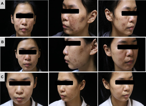 Figure 1 Clinical photograph of a female patient showing improvement in minocycline-induced hyperpigmentation before and after treatment. (A) Before treatment. (B) After three treatments of 35% fruit acids. (C) After three intense pulsed light treatments.