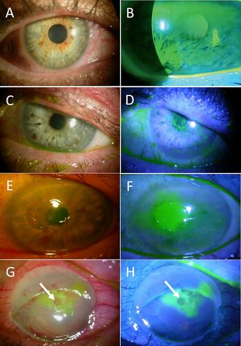 Figure 3 Stages of neurotrophic keratitis: Impaired cornea sensitivity and lack of trophic support trigger nonspecific epithelial irregularity and tear ﬁlm changes (A, B). Stage 1- mild (C, D) is characterized by corneal punctate keratopathy due to focal epithelial damage and loss of tight junctions. It is associated with mild stromal edema with or without corneal neovascularization. Stage 2 – moderate (E, F) is distinguished by the presence of central persistent epithelial defect, surrounded by edematous, cloudy, and poorly adherent epithelium. Stage 3- severe (G, H) is characterized by stromal ulceration and thinning that may progress to melting and perforation (arrows).