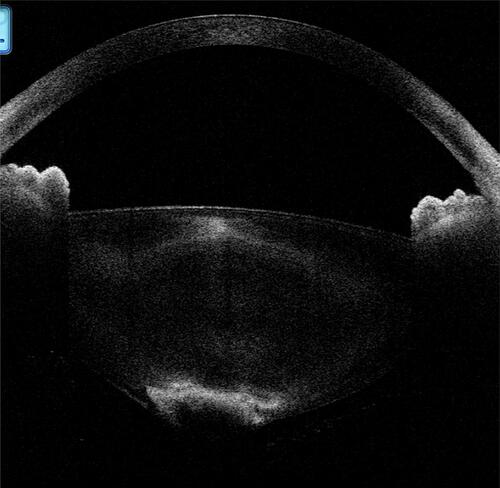 Figure 12 In another posterior polar cataract, the posterior lenticular appearance with deficient capsule can be configured as a moth-eaten appearance.