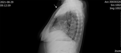 Figure 2 On August 29, 2021, X-ray images were taken of the patient chest. The X-rays showed that increased density at the arrow, considering possible infection.