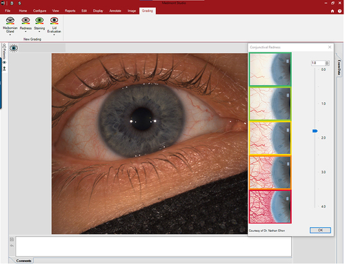 Figure 9 Image capture to document baseline findings. The Efron grading scaleCitation19–21 is used to grade eye redness.