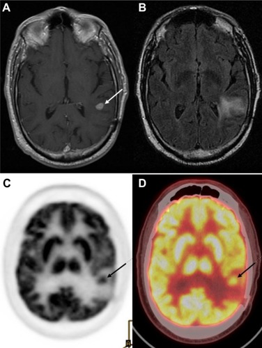 Figure 4 Tumor recurrence versus radiation induced changes: images of a 77-year-old male who was originally diagnosed with glioblastoma multiforme, treated with external beam radiation and adjuvant chemotherapy with temozolomide.Notes: Ten-month follow-up MR T1 post-contrast images (A) demonstrate a distinct area of enhancement (arrow) in the left temporoparietal lobe region of prior tumor. T2-weighted MR images (B) demonstrate hyperintense signal in the left parietal lobe extending to the left temporal lobe. This pathologic contrast enhancement is suggestive of an infiltrative mass. FDG PET only (C) and PET-CT fusion images (D) demonstrate a focus of increased FDG activity corresponding to an enhanced area of uptake on post-contrast T1 images. These findings are consistent with tumor recurrence. There is also decreased tracer uptake surrounding these areas consistent with vasogenic edema.Abbreviations: CT, computed tomography; FDG, 2-fluorodeoxyglucose; MR, magnetic resonance; PET, positron emission tomography.