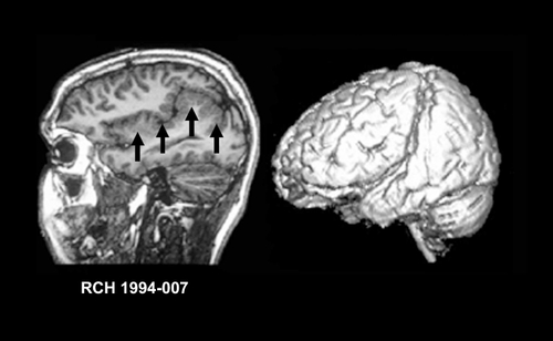 Figure 8. MRI features of polymicrogyria. T1-weighted parasagittal image (left) of a patient with perisylvian polymicrogyria (PMG) showing an abnormally extended Sylvian fissure surrounded by overfolded gray matter with an irregular surface and stippling of the graywhite junction (arrows). The image on the right is a 3D surface reconstruction of another patient with perisylvian PMG highlighting the abnormal extension and orientation of the Sylvian fissure. MRI, magnetic resonance imaging