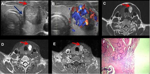 Figure 2 Images from a representative PTC patient with minimal ETE in the left thyroid lobe (female, 41 years old). (A) Transverse view of US image shows an oval hypoechoic in the left thyroid lobe, protruded the anterior thyroid capsule (red arrow), invading the tracheal mucosa (blue arrow, over-diagnosis), (B) Doppler shows abundant blood flow signals inside and a low blood flow signal around the thyroid capsule, (C) T2WI image, (D) fat-saturated T2WI image, (E) contrast-enhanced T1WI image shows a round lesion in the left lobe of the thyroid with clear boundaries, protrusion of the lesion outside the anterior thyroid capsule (red arrow), and no invasion of tracheal mucosa, and (F) histopathological H&E (total magnification, 10×) image of a PTC showing minimal ETE (extension to sternothyroid muscle).