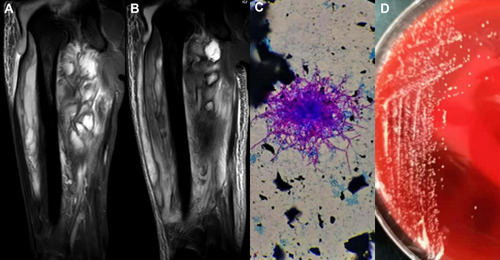 Figure 1 (A) MRI of the lower extremities showed multiple clumpy abnormal signal lesions, suspected of hematomas or abscesses formation. (B) Abnormal signal lesions decreased than before. (C) Modified Kinyoun acid-fast stain (1% sulfuric acid as a decolorizing agent) revealed red purple branching hyphae in multiple directions (10*100). (D) A routine blood agar plate at 48 hours revealed growth of small and hard white colonies.