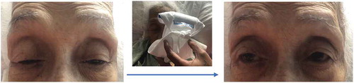 Figure 1. Positive ice pack test. A marked improvement of ptosis is noted after ice pack application for 2 minutes.