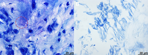 Figure 5 In postoperative pathology, Brucella (red circle) was positive for Giemsa staining while Mycobacterium tuberculosis was negative for acid-fast staining of the intervertebral disc of L3/4 and L4/5 (A and B).