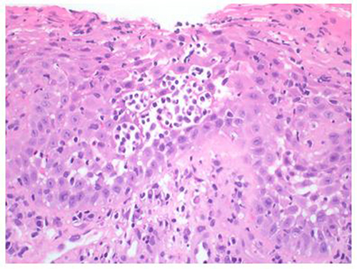 Figure 2 Hematoxylin and Eosin Stain, magnification X200, showing inflamed and ulcerated mucosa with focal thickening of the basement membrane, spongiotic pustules and intraepithelial microabscesses.