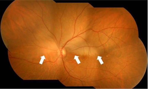 Figure 1 Left fundus photograph at the first visit showing retinal edema of the superior quadrant (arrow), sparing the fovea.