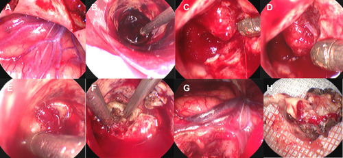 Figure 4 Surgical procedure of cAVM removal in the 67-year-old man via the transcranial neuroendoscopic approach. (A) After opening the dura mater, a red-colored draining vein was found. (B) The hematoma was evacuated under the visualization of the neuroendoscope. (C) The AVM nidus was located. (D) The feeding artery of the AVM was located. (E) The draining vein was identified. (F) The feeding artery was isolated, cauterized and cut. (G) The draining vein became darker after the AVM was removed. (H) The operative sample of the AVM.