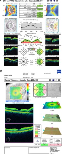 Figure 2 OCT of the optic nerve and macula. (A) Retinal nerve fiber layer analysis demonstrates 360° optic nerve edema in the right eye and no optic nerve edema in the left. (B) Macula OCT demonstrates a small area of subretinal fluid extending from the temporal portion of the optic disc into the nasal macula in the right eye.