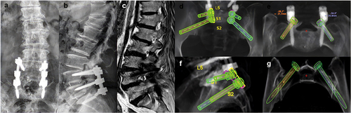 Figure 1 Preoperative x-ray showed S1 PS (a and b). Preoperative MRI showed L34 ASD (c). S1 CBT and S2AI screws were designed in the platform of the Mazor Renaissance spinal robot (d–g).