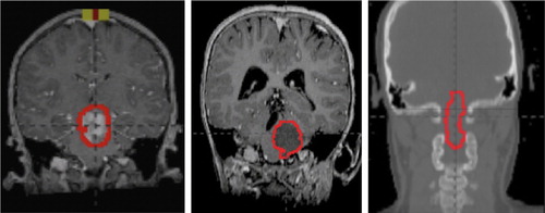 Figure 1. Coronal sections of patients 1–3 (from left to right) representing brainstem glioma location within brainstem with GTV outlined (red).