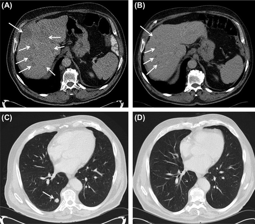 Figure 1. Axial computerized tomography at baseline showing multiple liver (A) and lung (C) metastases (arrows) and good regression at first evaluation (B and D), following 6 weeks of treatment with mebendazole.