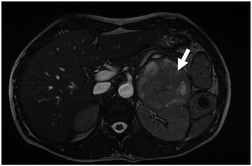 Figure 1. MRI showed a 9 × 6 cm-sized left adrenal mass, and the mass had hyperintense on T2- weighted image with necrotic areas (arrow).