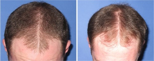 Figure 10 Baseline (left) versus 24-week (right) global photograph of treated (fat alone) hairline.