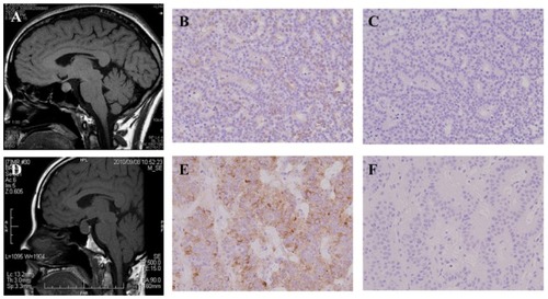 Figure 3 Magnetic resonance imaging (MRI) and immunohistochemical findings of the two cases. (A and D) T1-weighted MRI images of Cases 1 and 2, respectively. Pituitary tumor was seen in each case. (B and E) Immunohistochemistry for follicle-stimulating hormone (FSH) in pituitary tumors derived from Cases 1 and 2, respectively. Positive staining for FSH was done for each specimen. (C and F) Immunohistochemistry for LH in pituitary tumors derived from Cases 1 and 2, respectively.