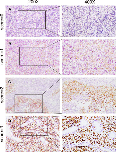 Figure 1 Representative immunohistochemical images of hPC2protein in NPC. The score indicates intensity of staining. (A) Score=0, negative staining; (B) score=1, weak staining; (C) score=2, moderate staining; (D) score=3, strong staining, magnification, left panel 200x, right panel 400x.