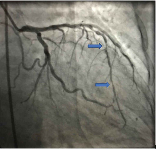 Figure 1. Invasive angiogram identifying mid and distal LAD lesions.