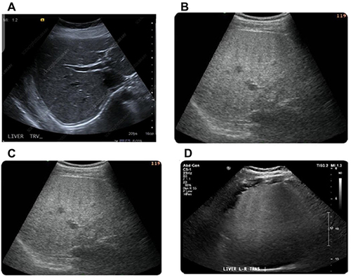 Figure 3 Ultrasound (US) imaging of liver in healthy persons and overweight as well as class I and II obese patients. Normal liver contrast with white asterisks demarcating normal hepatic parenchyma for comparison at same depth (A). US of overweight diabetic patients showed the presence of fatty liver with increased liver echogenicity (B). Also, fatty liver with mild hepatic echogenicity obscuring was apparent in class I obese diabetic patients (C). In addition, US liver examination of class II obese diabetic patients showed a marked fatty liver with echogenic liver obscuring the echogenic walls of portal venous branches (D).