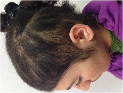 Figure 2. Scalp area showing irregular 2–3 cm length broken hairs on both sides of parietal and occipital regions.