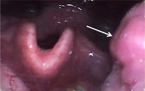 Figure 1 Laryngoscopy image showing a tender mass in the left tonsil (arrow).