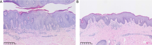 Figure 1 Histopathology (H&E) of skin. (A) A biopsy of the back lesions before using secukinumab describes features of psoriasis, including epidermal hyperkeratosis and acanthosis with elongation of the rete ridges. (B) Skin biopsy pathology of the groin after 8 months of secukinumab treatment illustrates epidermal hyperkeratosis, spongiosis, and a little eosinophil.