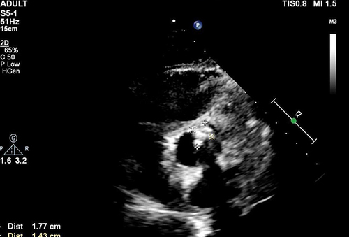 Figure 1 The results of transesophageal echocardiography.