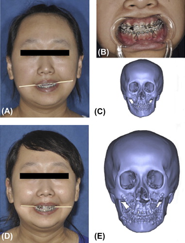 Figure 13. (A) Patient's preoperative frontal view. (B) Frontal view of centric occlusion with transverse maxillary cant and maxilla midline deviation. (C) Preoperative 3D model reconstructed based on CT scanning. (D) Postoperative frontal view: the patient's maxillary transverse cant and midline deviation were corrected as the preoperative surgical design. (E) Postoperative 3D model reconstructed based on CT scanning. Adapted from reference (Citation192) with permission of Oral Surgery, Oral Medicine, Oral Pathology, Oral Radiology, and Endodontology, Elsevier, Copyright 2010.