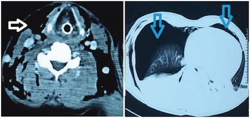 Figure 3. CT scan showing extensive subcutaneous emphysema of the neck (horizontal arrow) and bilateral pneumothorax (vertical arrow).