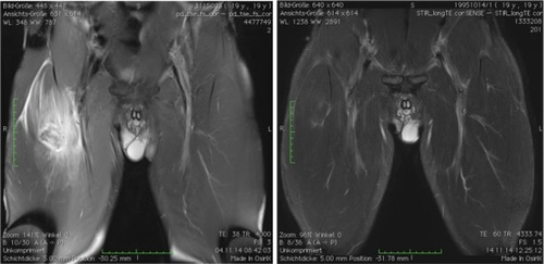 Figure 3 Acute muscle rupture of the rectus femoris.